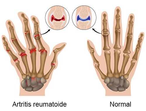 Artritis : Bikin Hidup Makin Meringis