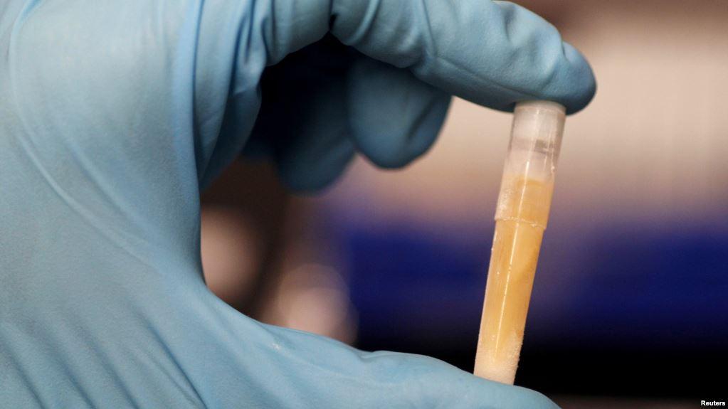 Jepang akan Mulai Uji Coba Tes Urine untuk Deteksi Kanker