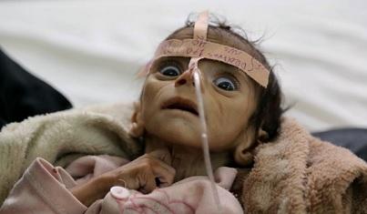 UNICEF: Delapan Anak Yaman Terbunuh atau Terluka Setiap Harinya 