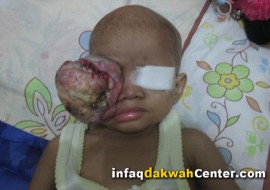 Dua Tahun Nuraini Menahan Sakit Tumor Mata. Cita-citanya Ingin Jadi Ustadzah. Ayo Bantu!!